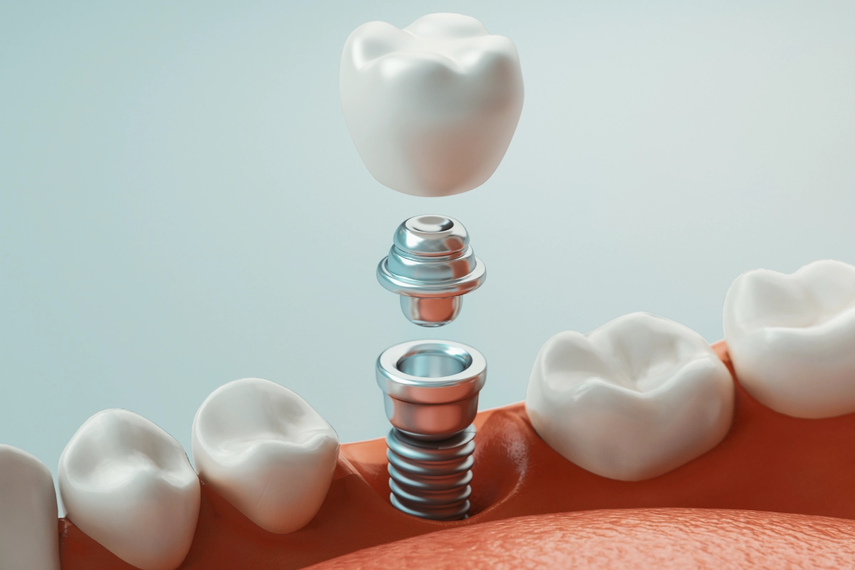 Level 2 β Entry-Level Implant Placement