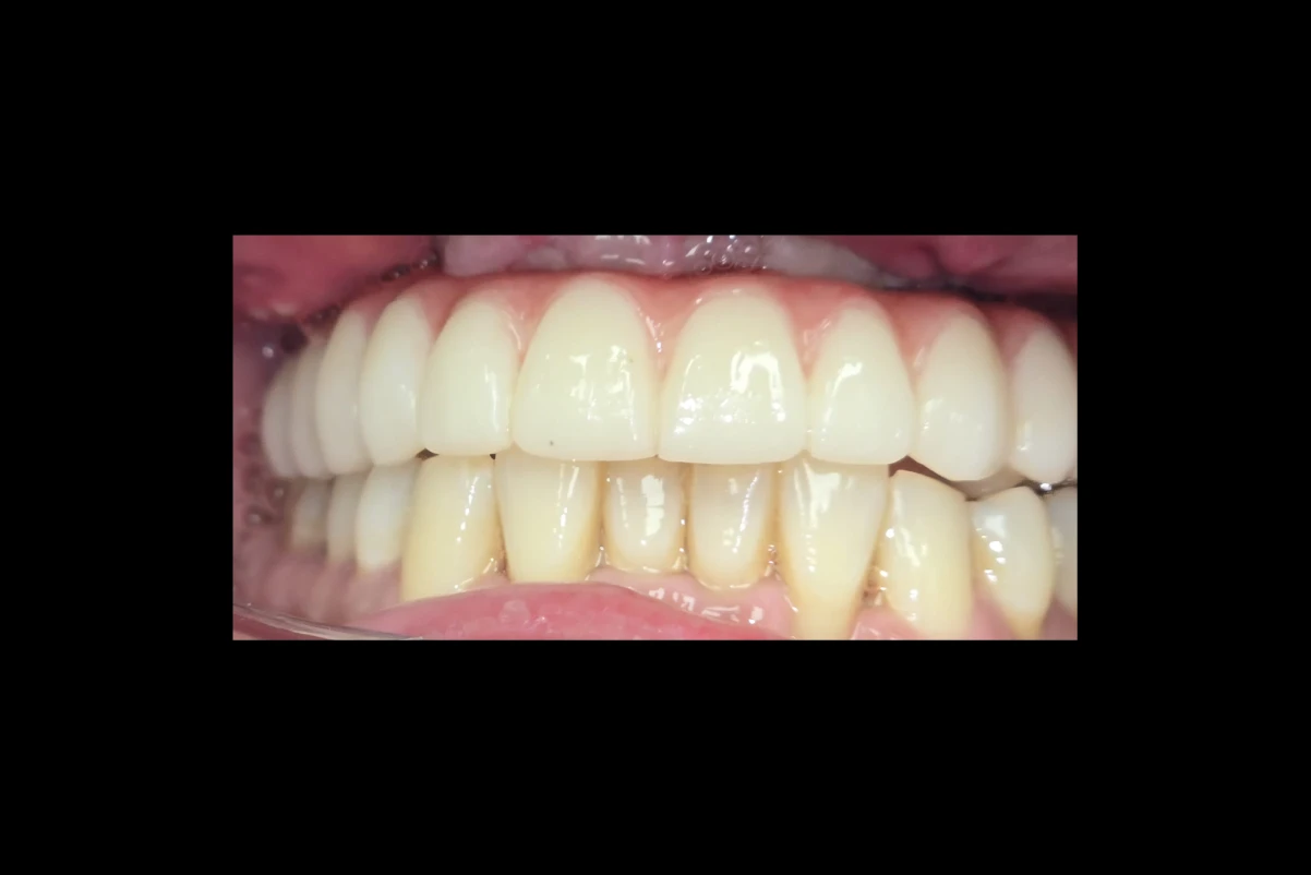 Implant Restoration